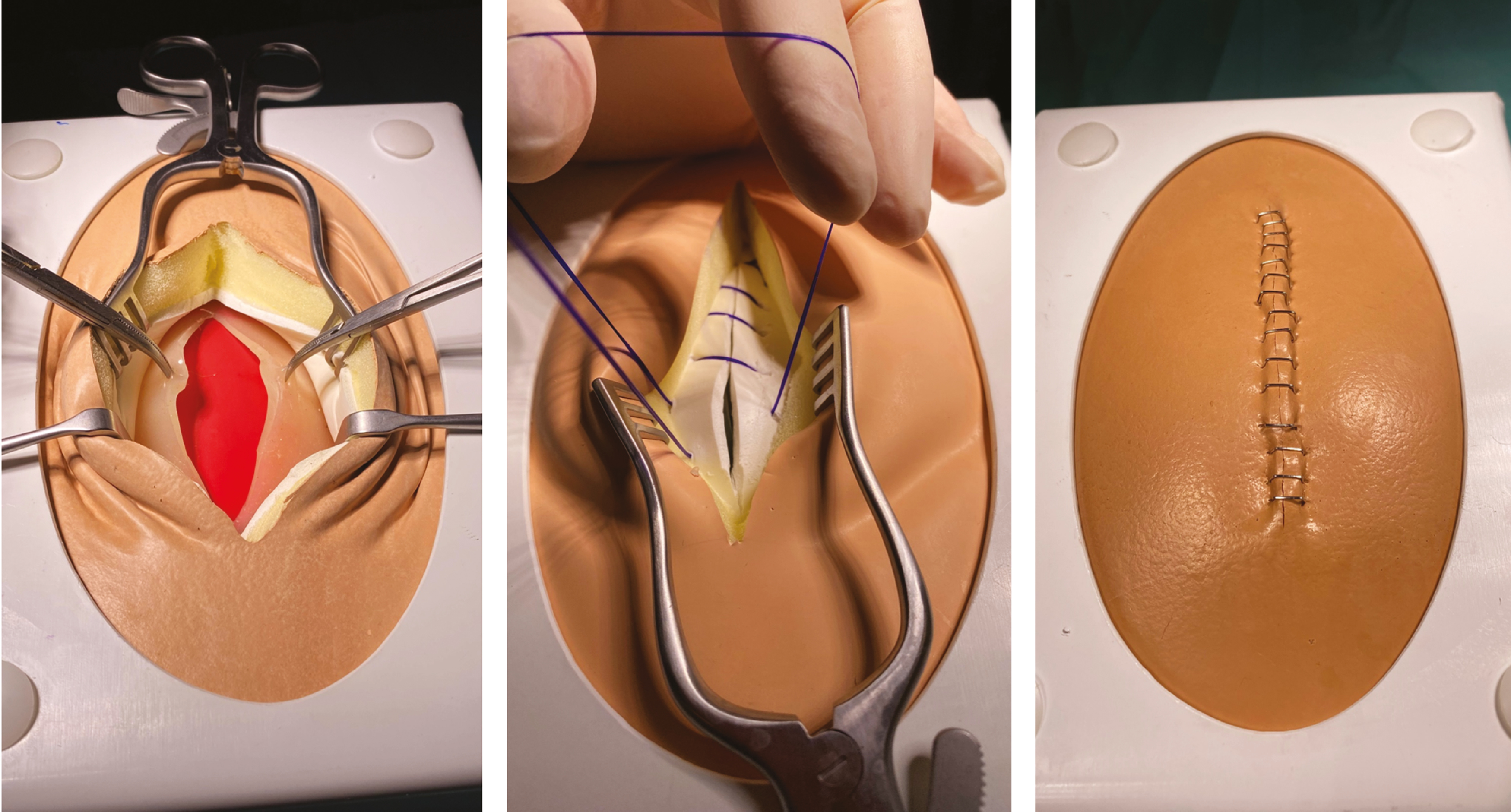 The tissue layers are exposed, with two small artery forceps manipulating the peritoneal layer (left). Closure of linea alba using continuous sutures (middle). Closure of skin using staples (right).