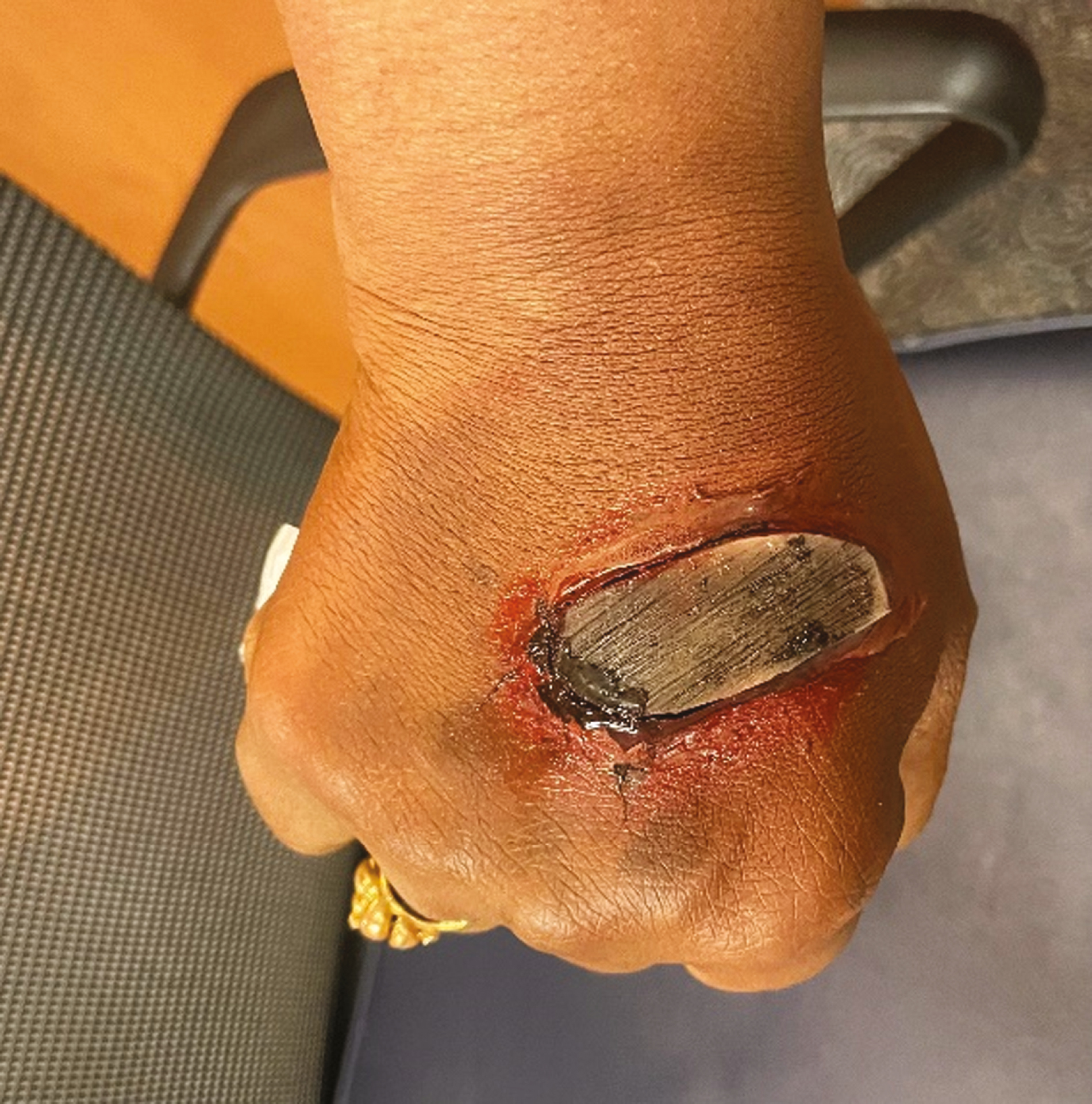 Ulcer with a black center caused by cutaneous anthrax simulated on right hand of patient actor using moulage